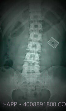 X射线扫描器胃截图4 X射线扫描器胃截图4