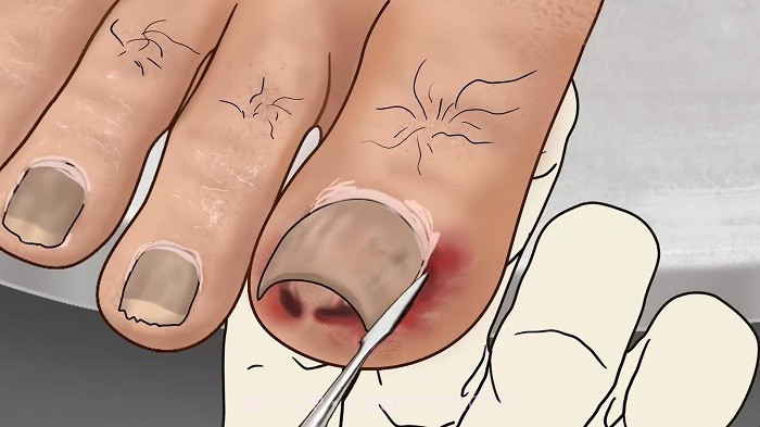 修脚足疔模拟器精简版截图1 修脚足疔模拟器精简版截图1